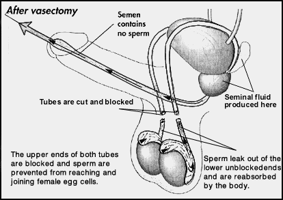 Laser vasectomy Australia