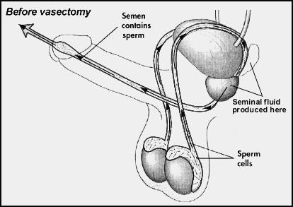 Get a scalpless vasectomy